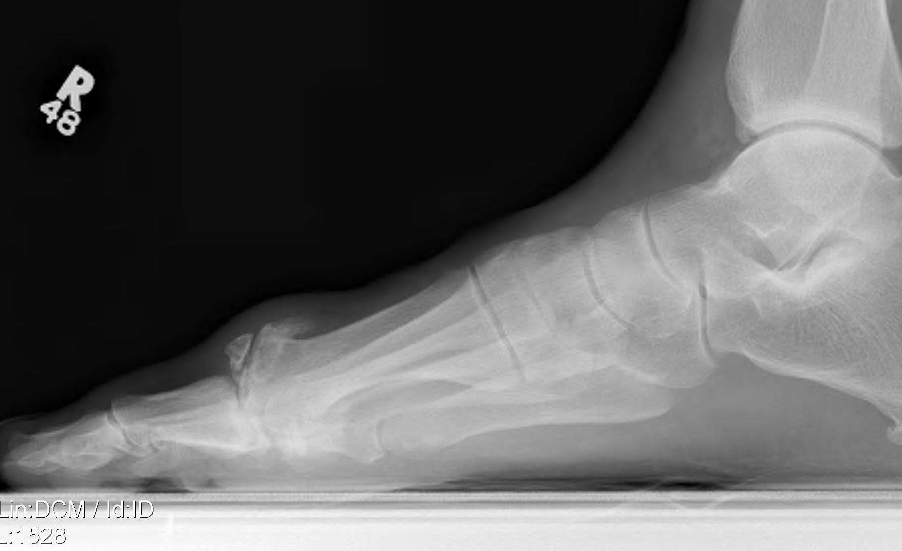 Hallux Rigidus Dorsal Osteophyte